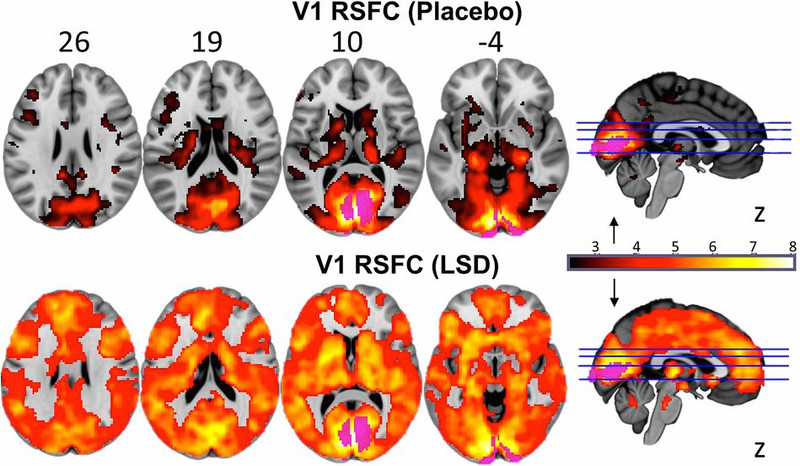 Brain images of the effects of LSD.