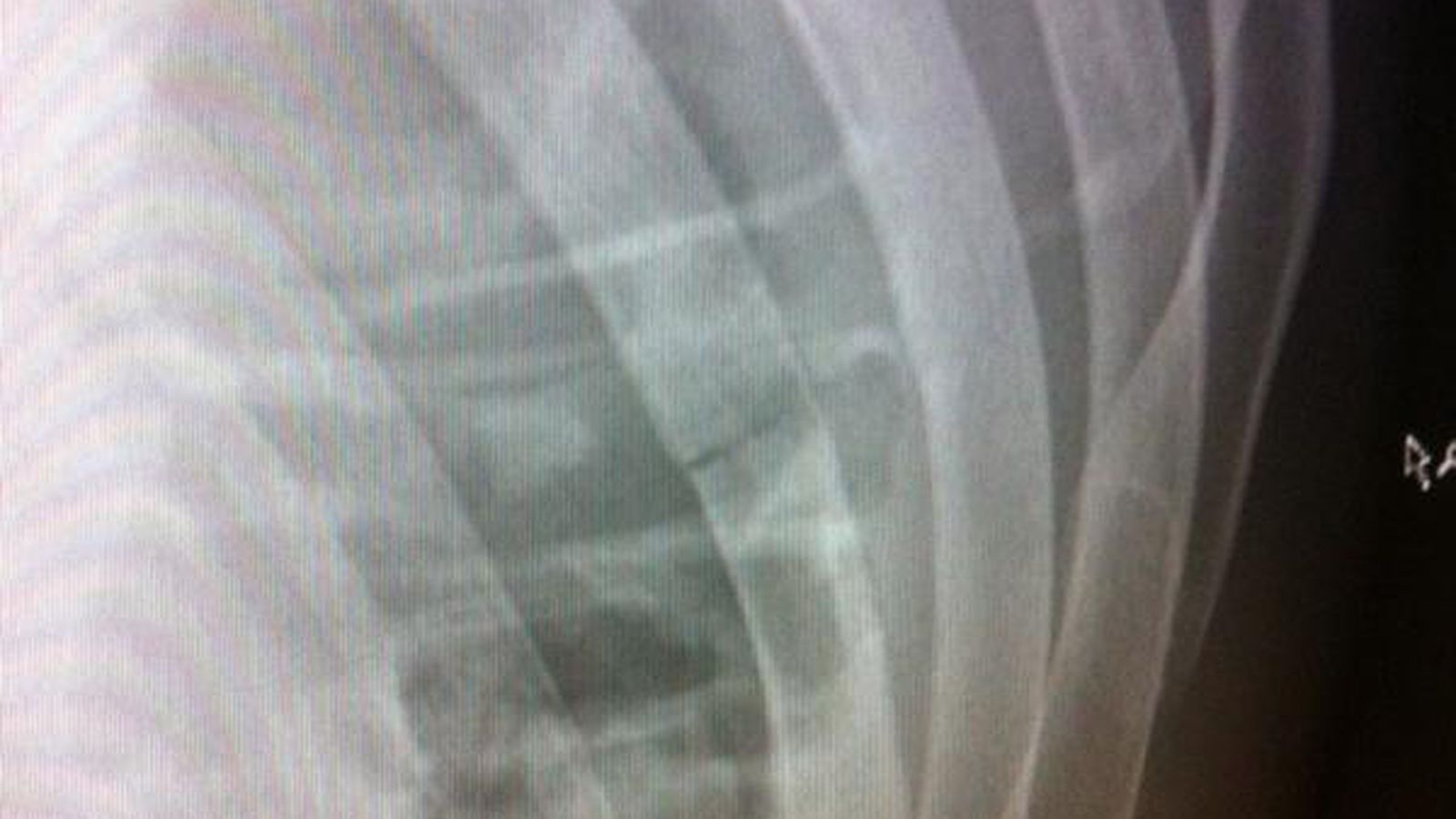 UFC 149 Photo: X-Ray Of Urijah Faber's Broken Rib From ...