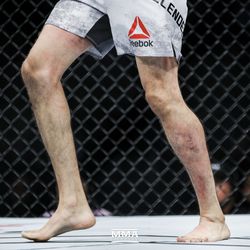 Gilbert Melendez’s leg gets severely damaged at UFC 215.